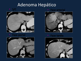 Adenoma Hepático
 S/C                Fase arterial




 Fase portal        Fase tardia
 
