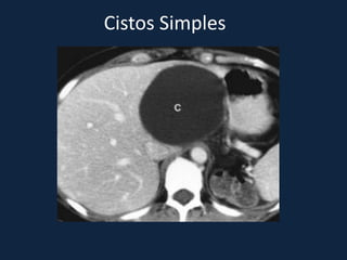 Cistos Simples
 
