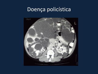 Doença policística
 