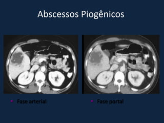 Abscessos Piogênicos




 Fase arterial         Fase portal
 