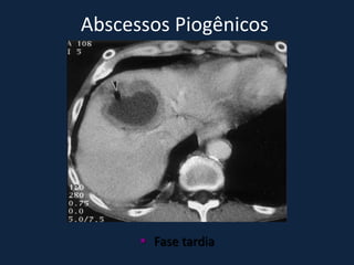 Abscessos Piogênicos




       Fase tardia
 