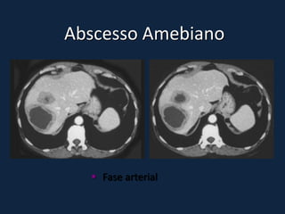 Abscesso Amebiano




   Fase arterial
 