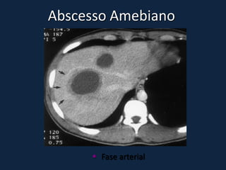 Abscesso Amebiano




      Fase arterial
 