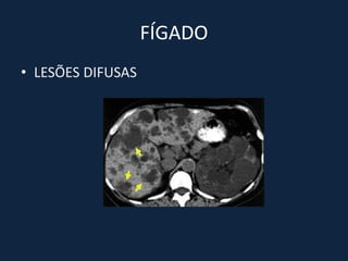 FÍGADO
• LESÕES DIFUSAS
 