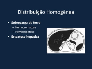 Distribuição Homogênea
• Sobrecarga de ferro
  – Hemocromatose
  – Hemossiderose
• Esteatose hepática
 