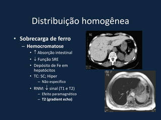 Distribuição homogênea
                                  TC
• Sobrecarga de ferro
  – Hemocromatose
     •  Absorção intestinal
     •  Função SRE
     • Depósito de Fe em
       hepatócitos
     • TC: SC; Hiper                   T1

         – Não específico
     • RNM:  sinal (T1 e T2)
         – Efeito paramagnético
         – T2 (gradient echo)

                                            *
 