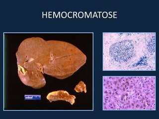 HEMOCROMATOSE
 