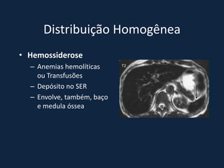 Distribuição Homogênea
• Hemossiderose
  – Anemias hemolíticas     T2

    ou Transfusões
  – Depósito no SER
  – Envolve, também, baço
    e medula óssea
 