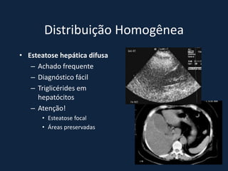 Distribuição Homogênea
• Esteatose hepática difusa
   – Achado frequente
   – Diagnóstico fácil
   – Triglicérides em
     hepatócitos
   – Atenção!
      • Esteatose focal
      • Áreas preservadas
 