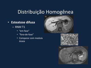 Distribuição Homogênea
                              T1


• Esteatose difusa
   – RNM T1
      • “em-fase”
      • “fora-de-fase”
      • Comparar com medula
        óssea

                                   T1
 