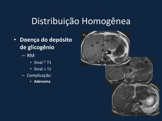 Distribuição Homogênea
                       T1
• Doença do depósito
  de glicogênio
  – RM
                                T1
     • Sinal  T1           *
     • Sinal  T2
  – Complicação:
      • Adenoma                  Normal




                                     T2
 