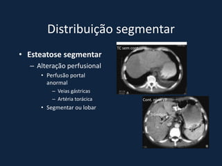 Distribuição segmentar
                              TC sem cont.
• Esteatose segmentar
  – Alteração perfusional
     • Perfusão portal
       anormal
         – Veias gástricas
         – Artéria torácica                  Cont. nível VP
     • Segmentar ou lobar
                                                 Trombose
 