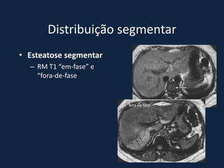 Distribuição segmentar
                                T1 “em fase”
• Esteatose segmentar
  – RM T1 “em-fase” e
    “fora-de-fase”


                        T1 “fora-de-fase”
 