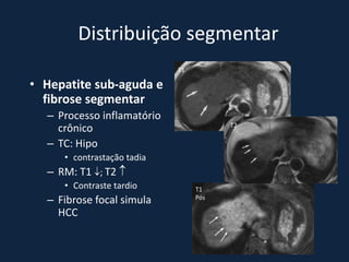 Distribuição segmentar
                            T1

• Hepatite sub-aguda e
  fibrose segmentar
  – Processo inflamatório
                                       T2
    crônico
  – TC: Hipo
     • contrastação tadia
  – RM: T1 ; T2 
     • Contraste tardio          T1
  – Fibrose focal simula         Pós

    HCC
 
