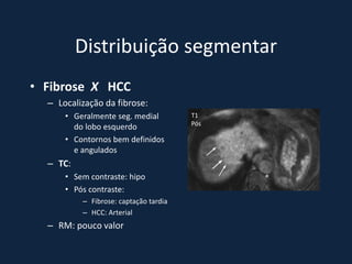 Distribuição segmentar
• Fibrose X HCC
  – Localização da fibrose:
      • Geralmente seg. medial         T1
                                       Pós
        do lobo esquerdo
      • Contornos bem definidos
        e angulados
  – TC:
      • Sem contraste: hipo
      • Pós contraste:
          – Fibrose: captação tardia
          – HCC: Arterial
  – RM: pouco valor
 