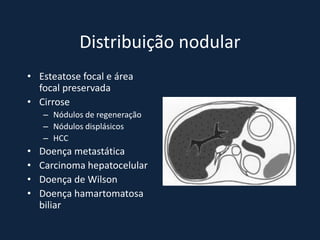 Distribuição nodular
• Esteatose focal e área
  focal preservada
• Cirrose
    – Nódulos de regeneração
    – Nódulos displásicos
    – HCC
•   Doença metastática
•   Carcinoma hepatocelular
•   Doença de Wilson
•   Doença hamartomatosa
    biliar
 