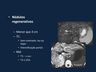 • Nódulos
  regenerativos
                               T2



  – Menor que 3 cm
  – TC:
     • Sem contraste: Iso ou
       hiper
     • Intensificação portal
  – RM:
     • T1:  ou 
     • T2: (Fe)
                                    Portografia
 