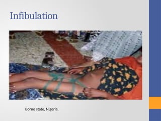 female genital mutilation circumstitpptx | PPTX