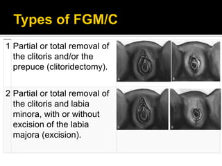Femal genital mutilation | PDF
