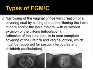 Femal genital mutilation | PDF