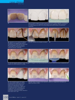 caso clínico
               White Post




  25.                                                26 e 27. Modelo de gesso da arcada superior obtido de um molde de alginato, e enceramento
                                                     dos elementos 11 e 21 restaurando suas bordas incisais desgastadas. Deste enceramento
                                                     foi confeccionada uma matriz com silicone pesado para auxílio durante o procedimento
                                                     restaurador.




  28. Inserção de um fio retrator Pro Retract        29 e 30. Canaletas de orientação do preparo.   30.
  00 (FGM) no sulco gengival para reduzir a
  possibilidade de contaminação da restauração
  pelo fluído gengival, tendo em vista que
  a restauração foi confeccionada sob um
  isolamento absoluto modificado.




  31, 32 e 33. Desgaste vestibular e incisal. Checagem do desgaste incisal (aproximadamente 2 mm) com a matriz de silicone, e acabamento dos
  preparos com discos Diamond Pro (FGM).




  34. Uma camada da massa mais opaca                 35 e 36. Preparo concluído, já sob isolamento. Observe um sangramento controlado com
  do sistema Opallis (FGM) que é a OW foi            agente hemostático (FGM).
  polimerizada em cima do preparo para
  conferir sua capacidade de mascarar
  totalmente o escurecimento. Chegou-se a
  conclusão que esta foi insuficiente, e só
  conseguiríamos isso se aumentássemos
  a espessura, o que comprometeria a
  profundidade superficial da faceta, deixando-a
  muito opaca e sem “vida”.




100     Revista FGMNews - volume 13 - Janeiro 2011
 