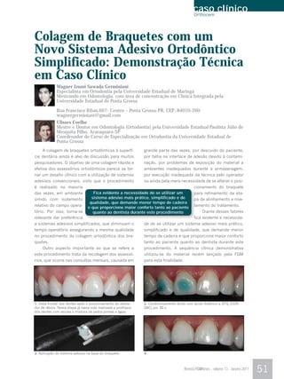 caso clínico
                                                                                               Orthocem




Colagem de Braquetes com um
Novo Sistema Adesivo Ortodôntico
Simplificado: Demonstração Técnica
em Caso Clínico
              Wagner Izumi Sawada Germiniani
              Especialista em Ortodontia pela Universidade Estadual de Maringá
              Mestrando em Odontologia, com área de concentração em Clínica Integrada pela
              Universidade Estadual de Ponta Grossa

              Rua Francisco Ribas,667- Centro – Ponta Grossa-PR, CEP: 84010-260
              wagnergerminiani@gmail.com
              Ulisses Coelho
              Mestre e Doutor em Odontologia (Ortodontia) pela Universidade Estadual Paulista Júlio de
              Mesquita Filho, Araraquara-SP
              Coordenador do Curso de Especialização em Ortodontia da Universidade Estadual de
              Ponta Grossa
     A colagem de braquetes ortodônticos à superfí-               grande parte das vezes, por descuido do paciente,
cie dentária ainda é alvo de discussão para muitos                por falha na interface de adesão devido à contami-
pesquisadores. O objetivo de uma colagem rápida e                 nação, por problemas de exposição do material a
efetiva dos assessórios ortodônticos parece se tor-               ambientes inadequados durante a armazenagem,
nar um desafio clínico com a utilização de sistemas               por execução inadequada da técnica pelo operador
adesivos convencionais, visto que o procedimento                  ou ainda pela mera necessidade de se alterar o posi-
é realizado na maioria                                                                          c
                                                                                                cionamento do braquete
das vezes, em ambiente               Fica evidente a necessidade de se utilizar um              p
                                                                                                para refinamento da eta-
úmido com isolamento                sistema adesivo mais prático, simplificado e de             p
                                                                                                pa de alinhamento e nive-
                                   qualidade, que demande menor tempo de cadeira
relativo do campo opera-          e que proporcione maior conforto tanto ao paciente            l
                                                                                                lamento do tratamento.
tório. Por isso, torna-se            quanto ao dentista durante este procedimento                    Diante desses fatores
relevante dar preferência                                                                       f
                                                                                                fica evidente a necessida-
a sistemas adesivos simplificados, que diminuam o                 de de se utilizar um sistema adesivo mais prático,
tempo operatório assegurando a mesma qualidade                    simplificado e de qualidade, que demande menor
no procedimento da colagem ortodôntica dos bra-                   tempo de cadeira e que proporcione maior conforto
quetes.                                                           tanto ao paciente quanto ao dentista durante este
     Outro aspecto importante ao que se refere a                  procedimento. A seqüência clínica demonstrativa
este procedimento trata da recolagem dos assessó-                 utilizou-se do material recém lançado pela FGM
rios, que ocorre nas consultas mensais, causada em                para esta finalidade.




1. Vista frontal dos dentes após o posicionamento do afasta-      2. Condicionamento ácido com ácido fosfórico a 37% (CON-
dor de lábios. Nesta etapa já havia sido realizada a profilaxia   DAC) por 30 s.
dos dentes com escova e mistura de pedra pomes e água.




3. Aplicação do sistema adesivo na base do braquete.              4.



                                                                                          Revista FGMNews - volume 13 - Janeiro 2011   51
 