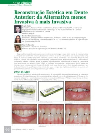 caso clínico
 Whiteness HP Maxx e Superendo




          Reconstrução Estética em Dente
          Anterior: da Alternativa menos
          Invasiva à mais Invasiva
                       Sergio Vieira
                       Especialista, Mestre e Doutor em Dentística, Professor Titular da PUCPR, Coordenador
                       do programa de Pós-Graduação em Odontologia da PUCPR, Coordenador do Curso de
                       Especialização em Dentística da ABO-PR
                       s.vieira@pucpr.br
                       Evelise Machado de Souza
                       Especialista, Mestre e Doutora em Dentística, Professora Titular da PUCPR, Responsável pela
                       área de concentração em Dentística do PPGO da PUCPR, Professora do Curso de Especialização
                       em Dentística da ABO-PR

                       Marcelo Taborda
                       Especialista e Mestre em Dentística
                       Professor do Curso de Especialização em Dentística da ABO-PR


               Os procedimentos estéticos revolucionaram a prática da odontologia, e o uso deste arsenal de maneira isolada
          ou integrada tem contribuído para resultados muito similares ao sorriso natural. Este caso objetiva mostrar uma
          opção de resolução estética para dente anterior que sofreu fratura, endodontia e escurecimento. Nesta situação
          sugere-se começar pelo tratamento mais conservador, clareamento dental. A técnica utilizada foi a associação do
          clareamento imediato e mediato. Apesar do sucesso após três sessões, houve recidiva no espaço de 3 semanas e
          uma faceta direta, com a Resina Opallis (FGM), foi realizada para mascarar o escurecimento dental. Apesar das
          técnicas menos invasivas, como o clareamento dental, neste caso, não surtirem o efeito desejado, elas devem ser
          tentadas inicialmente, pois funcionam na maioria dos casos e na pior das hipóteses possibilitam ao paciente um
          planejamento econômico para uma posterior solução estética.

          CASO CLÍNICO
              Paciente com 23 anos apresentando escurecimento do elemento 11, devido ao trauma seguido do tratamento
          endodôntico. O material obturador foi removido da câmara pulpar 2 mm em direção ao conduto. A técnica de cla-
          reamento utilizada foi a associação do clareamento em consultório (Whiteness HP Maxx), mais a técnica do clarea-
          mento interno (Whiteness Super Endo) – 2 sessões durante 3 dias.




     1. Whiteness HP Maxx.                         2. Whiteness Superendo.                        3 e 4. Aspecto do sorriso previamente ao
                                                                                                  clareamento.




     4.                                            5-8. Aspecto inicial do paciente com incisivo central escurecido devido ao tratamento
                                                   endodôntico.


66    Revista FGMNews - volume 13 - Janeiro 2011
 