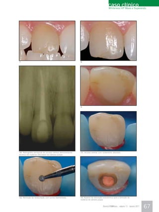 caso HP Maxx e Superendo
                                                                                            Whiteness
                                                                                                      clínico




7.                                                            8.




                                                              9.




10. Radiografia periapical do incisivo central demonstrando   11. Incisivo central com isolamento absoluto.
excesso de material obturador na câmara pulpar.




12. Remoção da restauração com ponta diamantada.              13. Aspecto da obturação endodôntica após a remoção de
                                                              material da câmara pulpar.


                                                                                       Revista FGMNews - volume 13 - Janeiro 2011   67
 