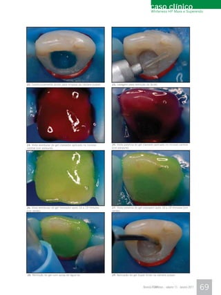 caso HP Maxx e Superendo
                                                                                             Whiteness
                                                                                                       clínico




22. Condicionamento ácido para limpeza da câmara pulpar.     23. Lavagem para remoção do ácido.




24. Vista vestibular do gel clareador aplicado no incisivo   25. Vista palatina do gel clareado aplicado no incisivo central
central (cor púrpura).                                       (cor púrpura).




26. Vista vestibular do gel clareador após 10 a 15 minutos   27. Vista palatina do gel clareador após 10 a 15 minutos (cor
(cor verde).                                                 verde).




28. Remoção do gel com spray de água/ar.                     29. Aplicação do gel Super Endo na câmara pulpar.



                                                                                       Revista FGMNews - volume 13 - Janeiro 2011   69
 