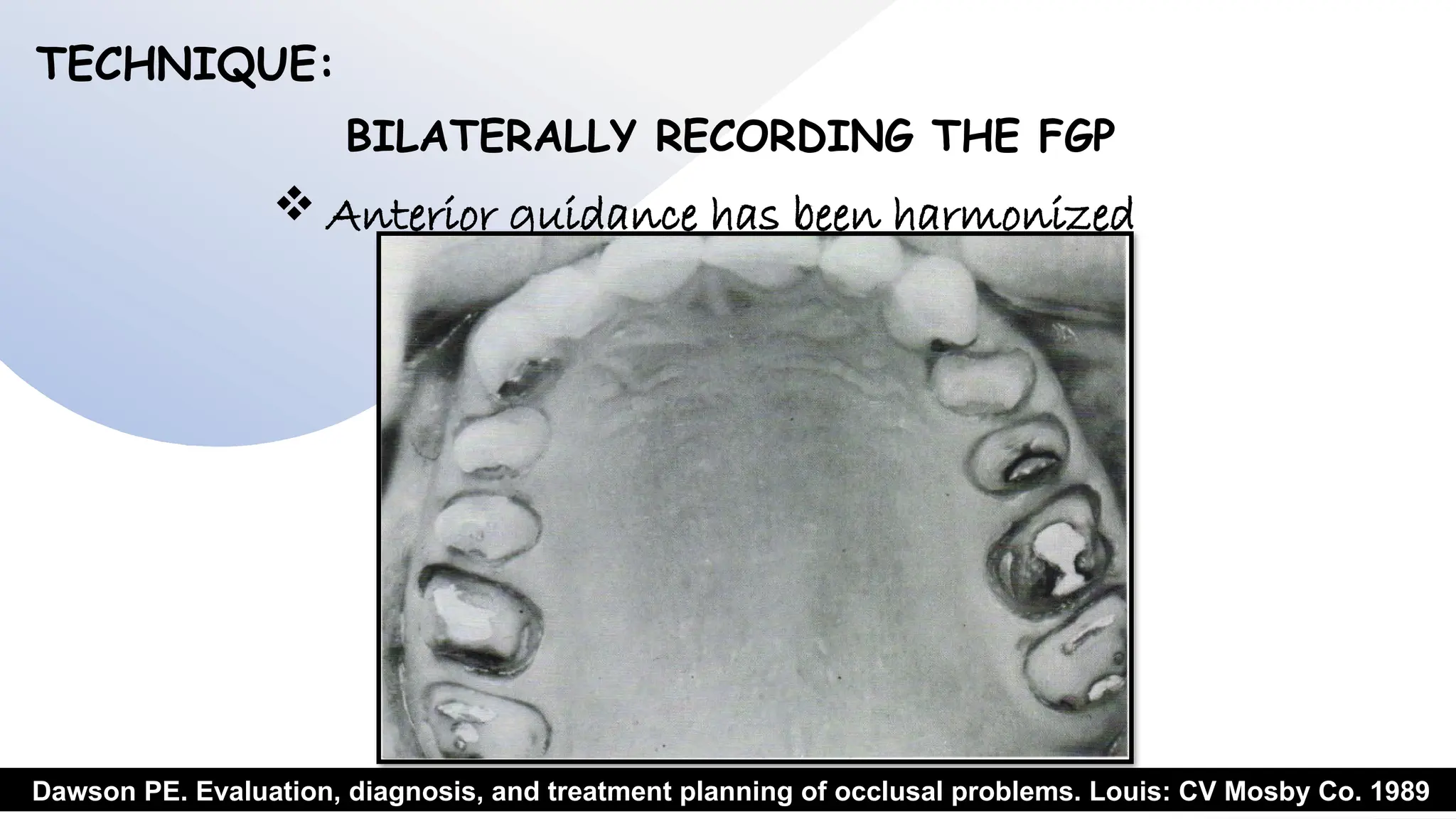 11
TECHNIQUE:
BILATERALLY RECORDING THE FGP
 Anterior guidance has been harmonized
Dawson PE. Evaluation, diagnosis, and treatment planning of occlusal problems. Louis: CV Mosby Co. 1989
 