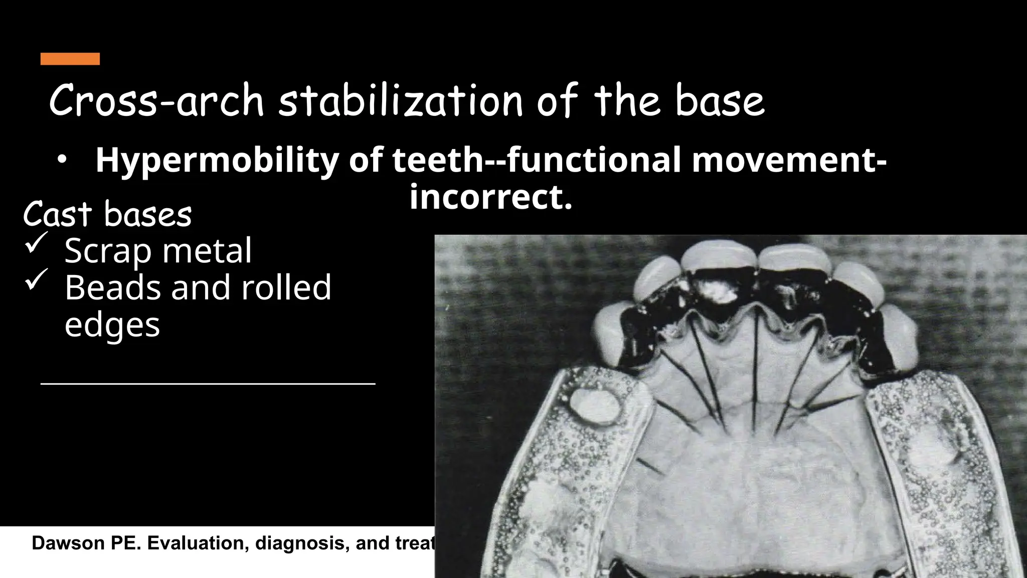Cross-arch stabilization of the base
14
• Hypermobility of teeth--functional movement-
incorrect.
Dawson PE. Evaluation, diagnosis, and treatment planning of occlusal problems. St Louis: CV Mosby Co.
1989:56-71.
Cast bases
 Scrap metal
 Beads and rolled
edges
 