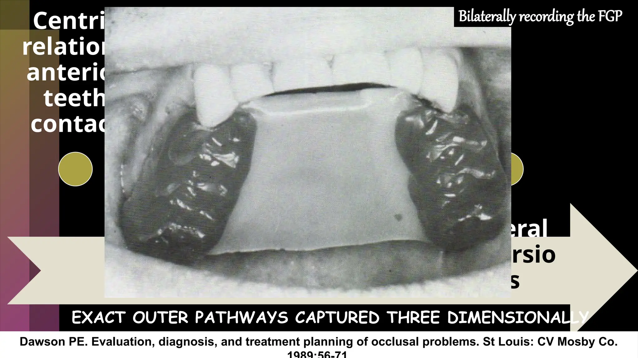18
Centric
relation :
anterior
teeth
contact
Slide
forward:
end to end
Close
back to
centric
relation
Lateral
excursio
ns
EXACT OUTER PATHWAYS CAPTURED THREE DIMENSIONALLY
Dawson PE. Evaluation, diagnosis, and treatment planning of occlusal problems. St Louis: CV Mosby Co.
Bilaterally recording the FGP
 