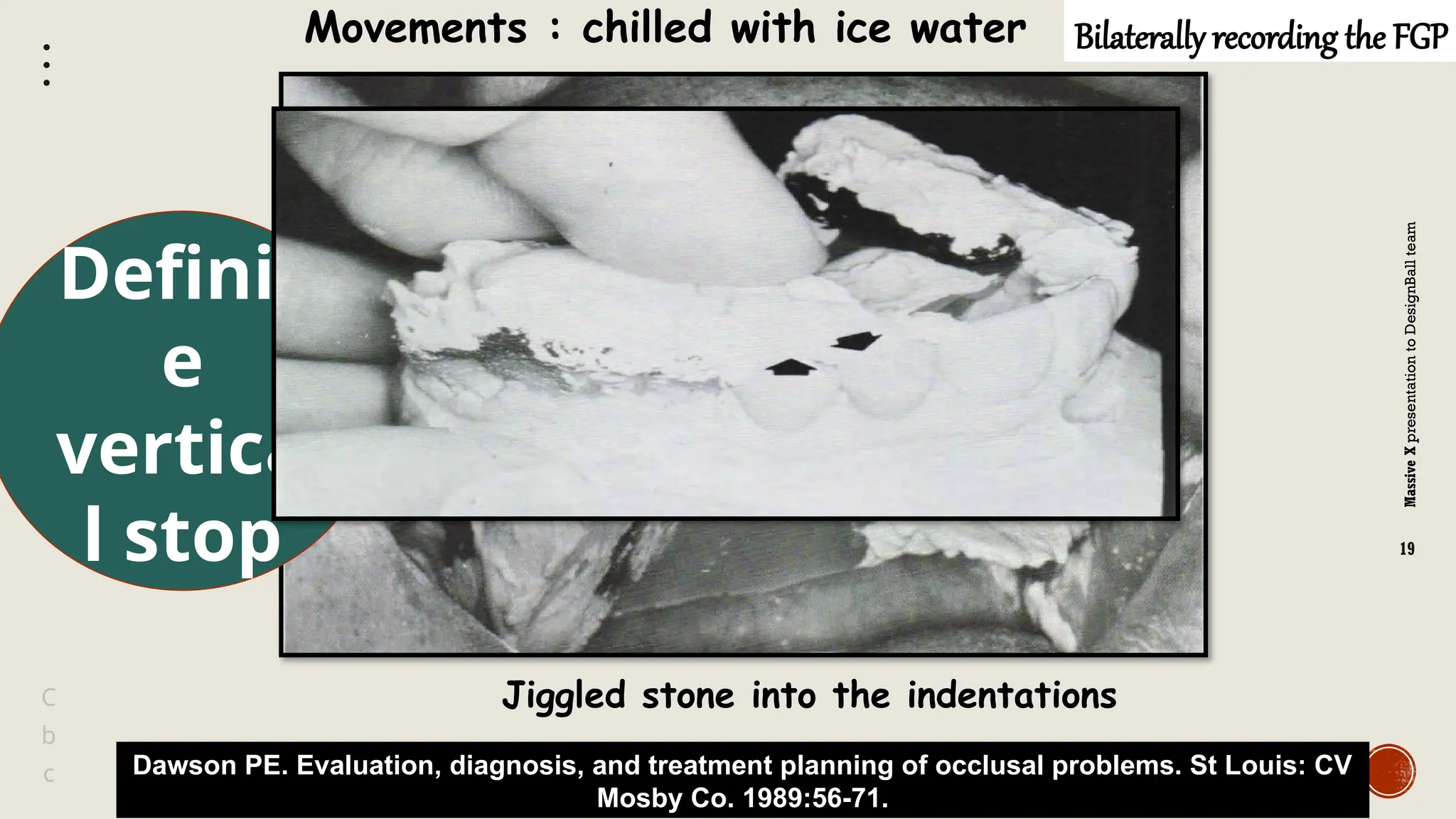 Massive
X
presentation
to
DesignBall
team
Massive
X
19
b
C
c
Bilaterally recording the FGP
Jiggled stone into the indentations
Movements : chilled with ice water
Dawson PE. Evaluation, diagnosis, and treatment planning of occlusal problems. St Louis: CV
Mosby Co. 1989:56-71.
Definit
e
vertica
l stop
 