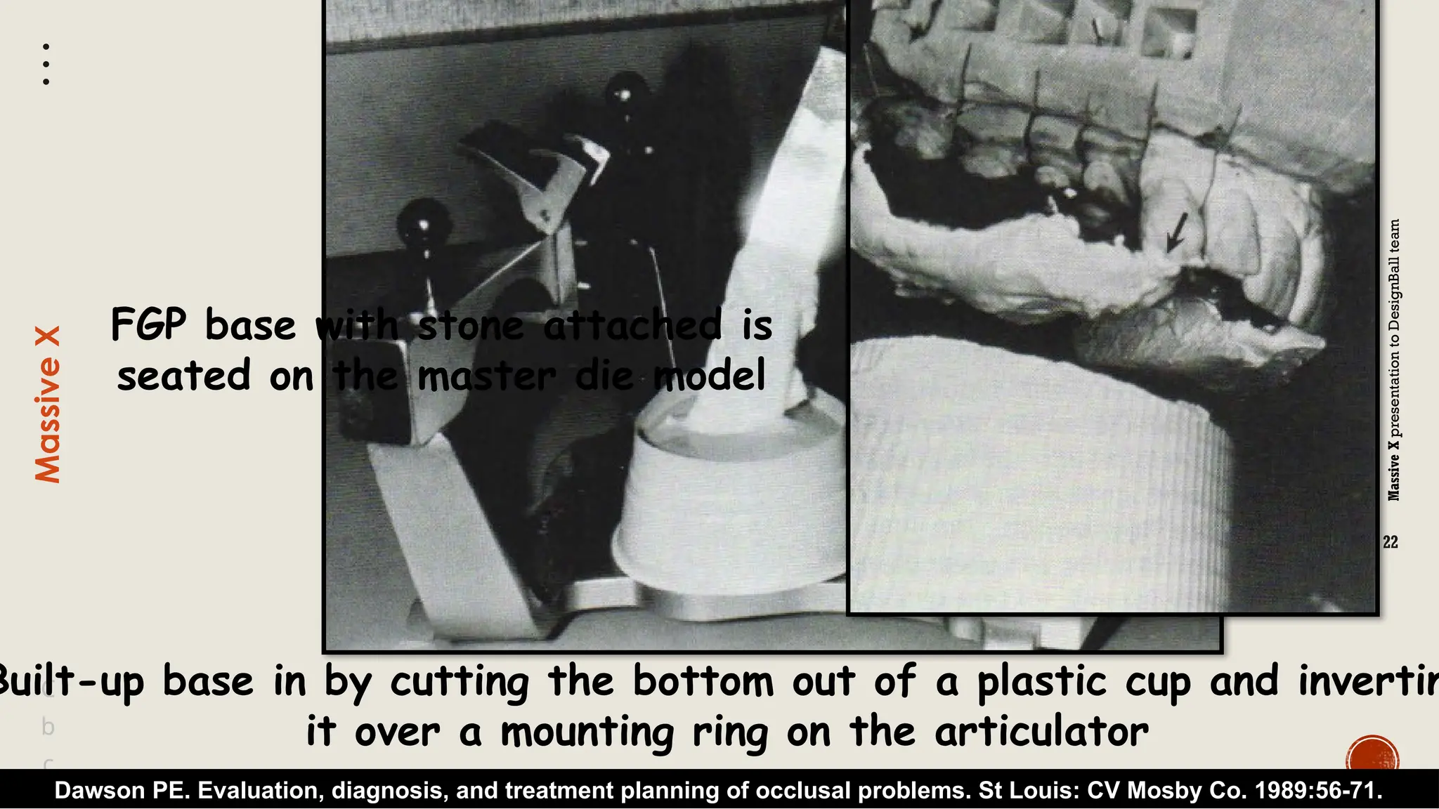 Massive
X
presentation
to
DesignBall
team
Massive
X
22
b
C
c
Built-up base in by cutting the bottom out of a plastic cup and invertin
it over a mounting ring on the articulator
Dawson PE. Evaluation, diagnosis, and treatment planning of occlusal problems. St Louis: CV Mosby Co. 1989:56-71.
FGP base with stone attached is
seated on the master die model
 