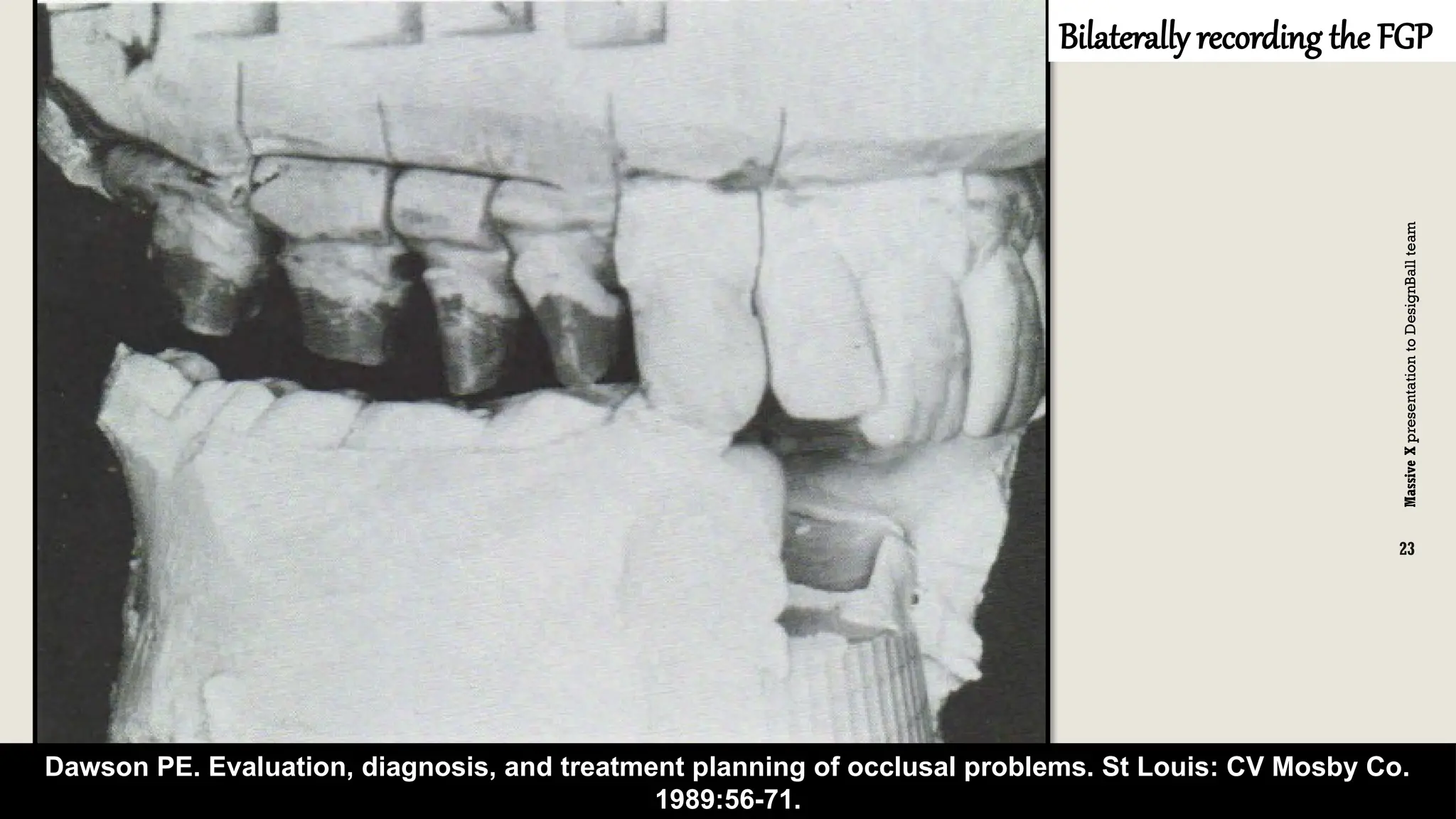 Massive
X
presentation
to
DesignBall
team
Massive
X
23
b
C
c
Dawson PE. Evaluation, diagnosis, and treatment planning of occlusal problems. St Louis: CV Mosby Co.
1989:56-71.
Bilaterally recording the FGP
 