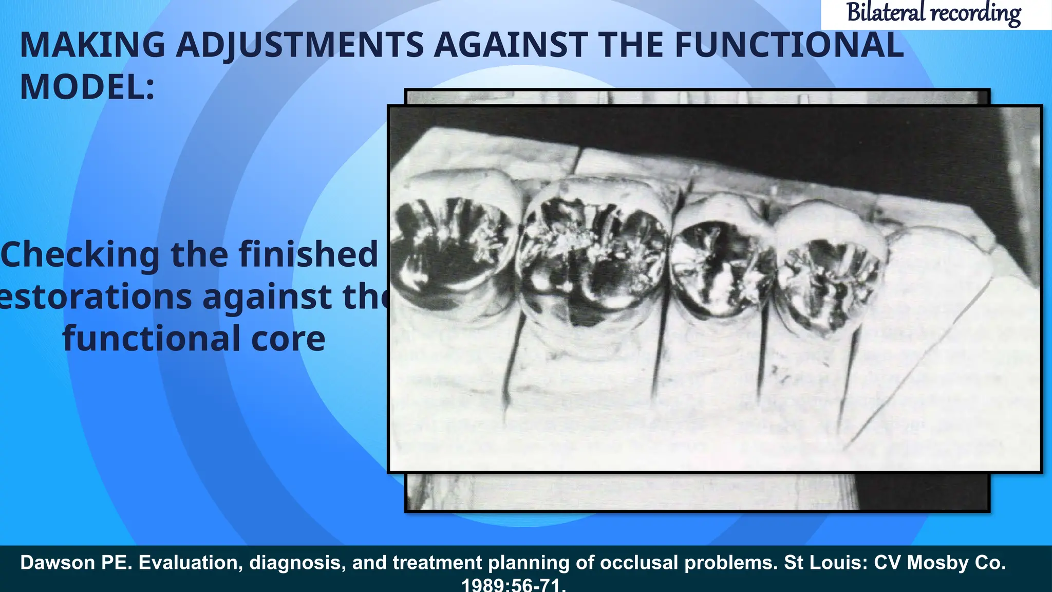 MAKING ADJUSTMENTS AGAINST THE FUNCTIONAL
MODEL:
Checking the finished
estorations against the
functional core
Dawson PE. Evaluation, diagnosis, and treatment planning of occlusal problems. St Louis: CV Mosby Co.
Bilateral recording
 