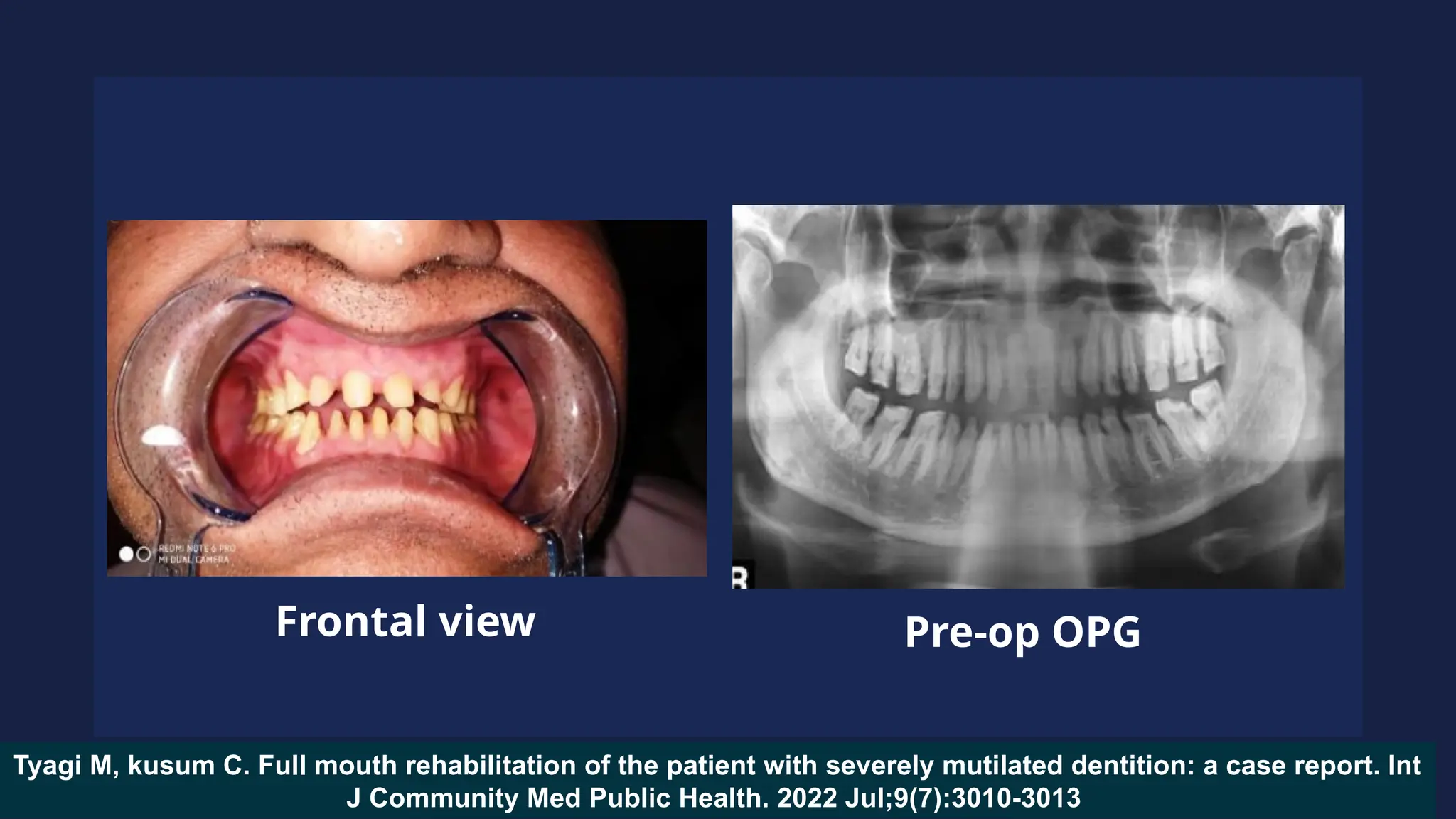 Frontal view Pre-op OPG
Tyagi M, kusum C. Full mouth rehabilitation of the patient with severely mutilated dentition: a case report. Int
J Community Med Public Health. 2022 Jul;9(7):3010-3013
 