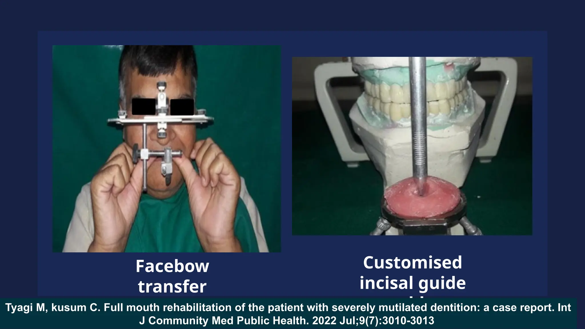 Facebow
transfer
Customised
incisal guide
table
Tyagi M, kusum C. Full mouth rehabilitation of the patient with severely mutilated dentition: a case report. Int
J Community Med Public Health. 2022 Jul;9(7):3010-3013
 
