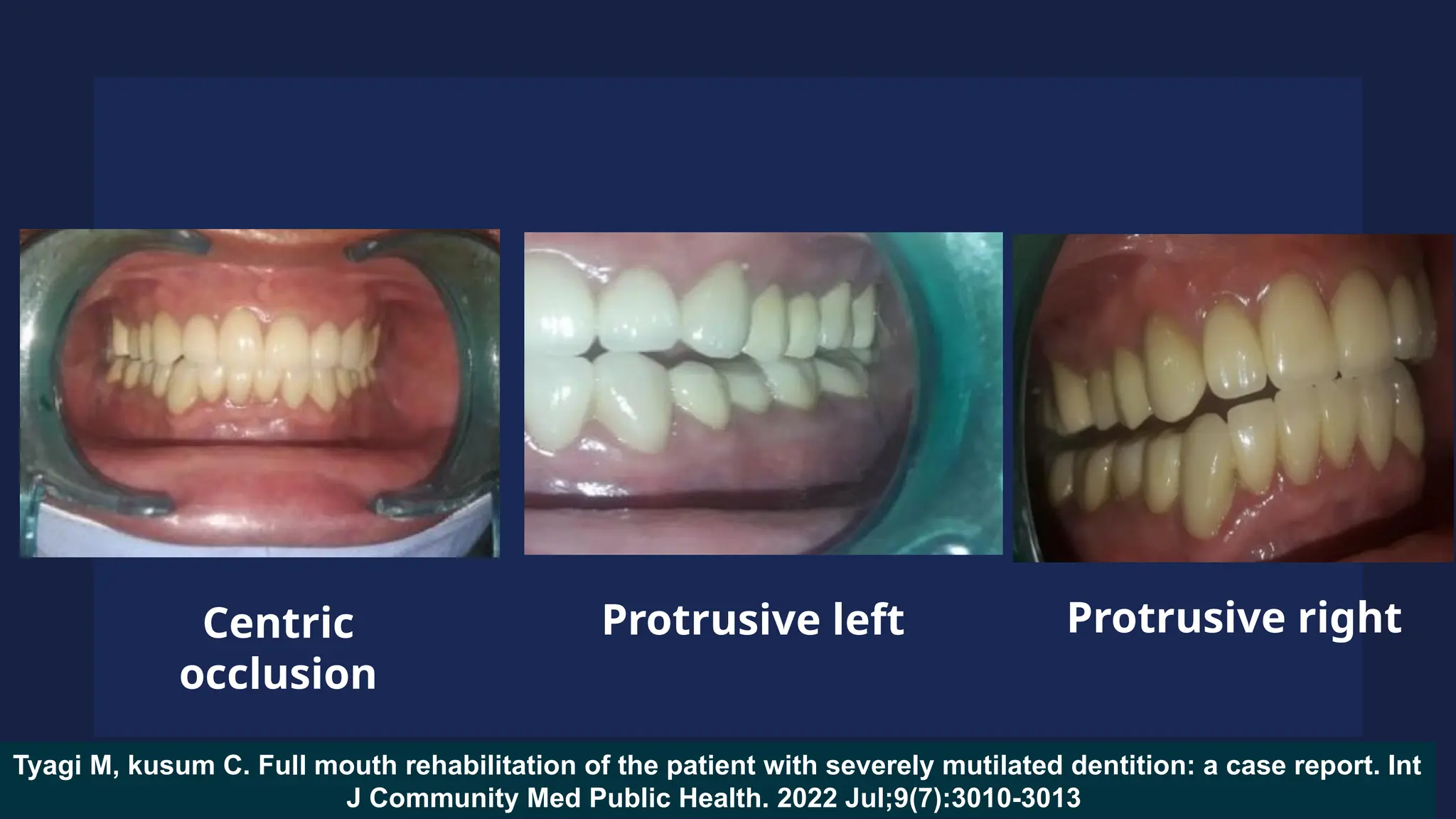 Tyagi M, kusum C. Full mouth rehabilitation of the patient with severely mutilated dentition: a case report. Int
J Community Med Public Health. 2022 Jul;9(7):3010-3013
Centric
occlusion
Protrusive right
Protrusive left
 