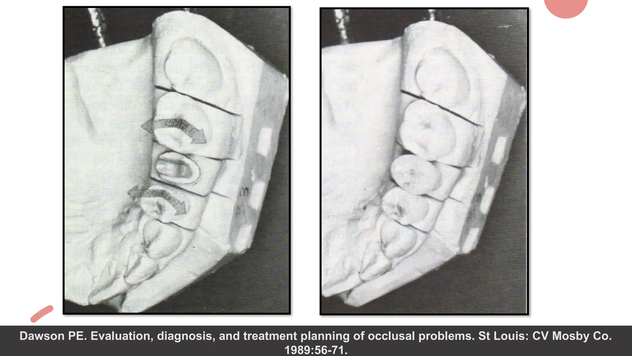 37
Dawson PE. Evaluation, diagnosis, and treatment planning of occlusal problems. St Louis: CV Mosby Co.
1989:56-71.
 