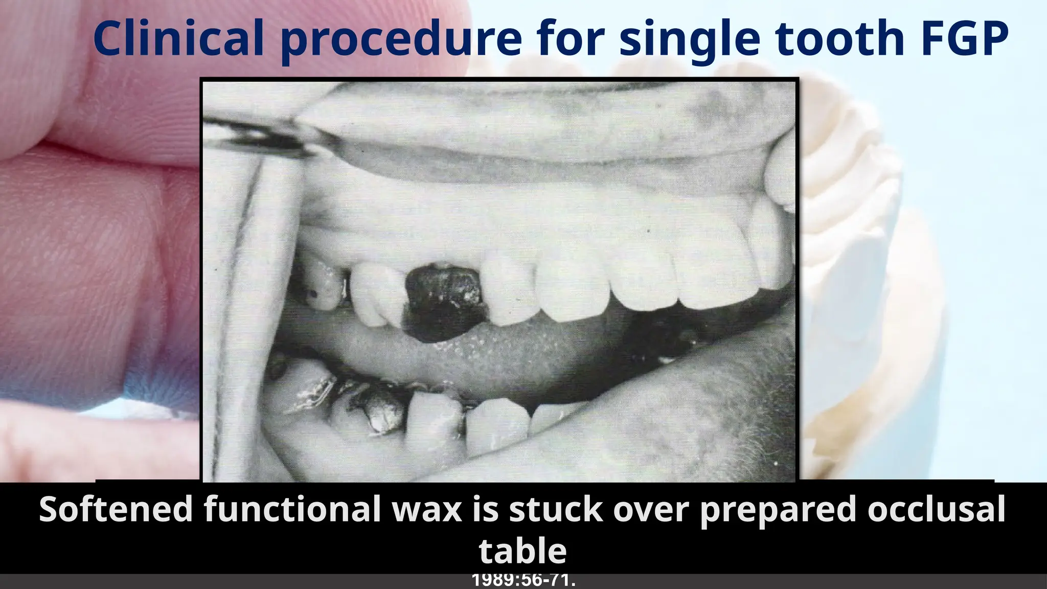 38
Clinical procedure for single tooth FGP
• Occlusal
reduction
Dawson PE. Evaluation, diagnosis, and treatment planning of occlusal problems. St Louis: CV Mosby Co.
1989:56-71.
Tooth stabilized with softened stick compound
Softened functional wax is stuck over prepared occlusal
table
 