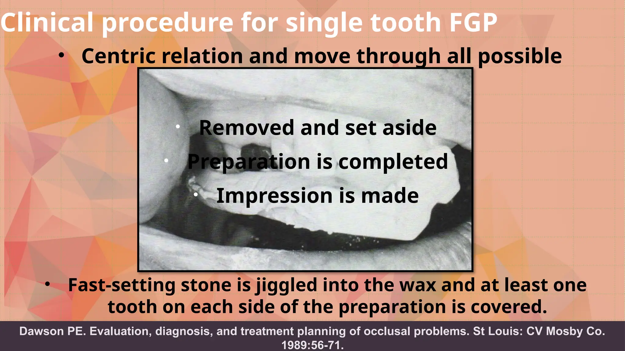 3 9
• Centric relation and move through all possible
excursions.
Clinical procedure for single tooth FGP
Dawson PE. Evaluation, diagnosis, and treatment planning of occlusal problems. St Louis: CV Mosby Co.
1989:56-71.
• Fast-setting stone is jiggled into the wax and at least one
tooth on each side of the preparation is covered.
• Removed and set aside
• Preparation is completed
• Impression is made
 