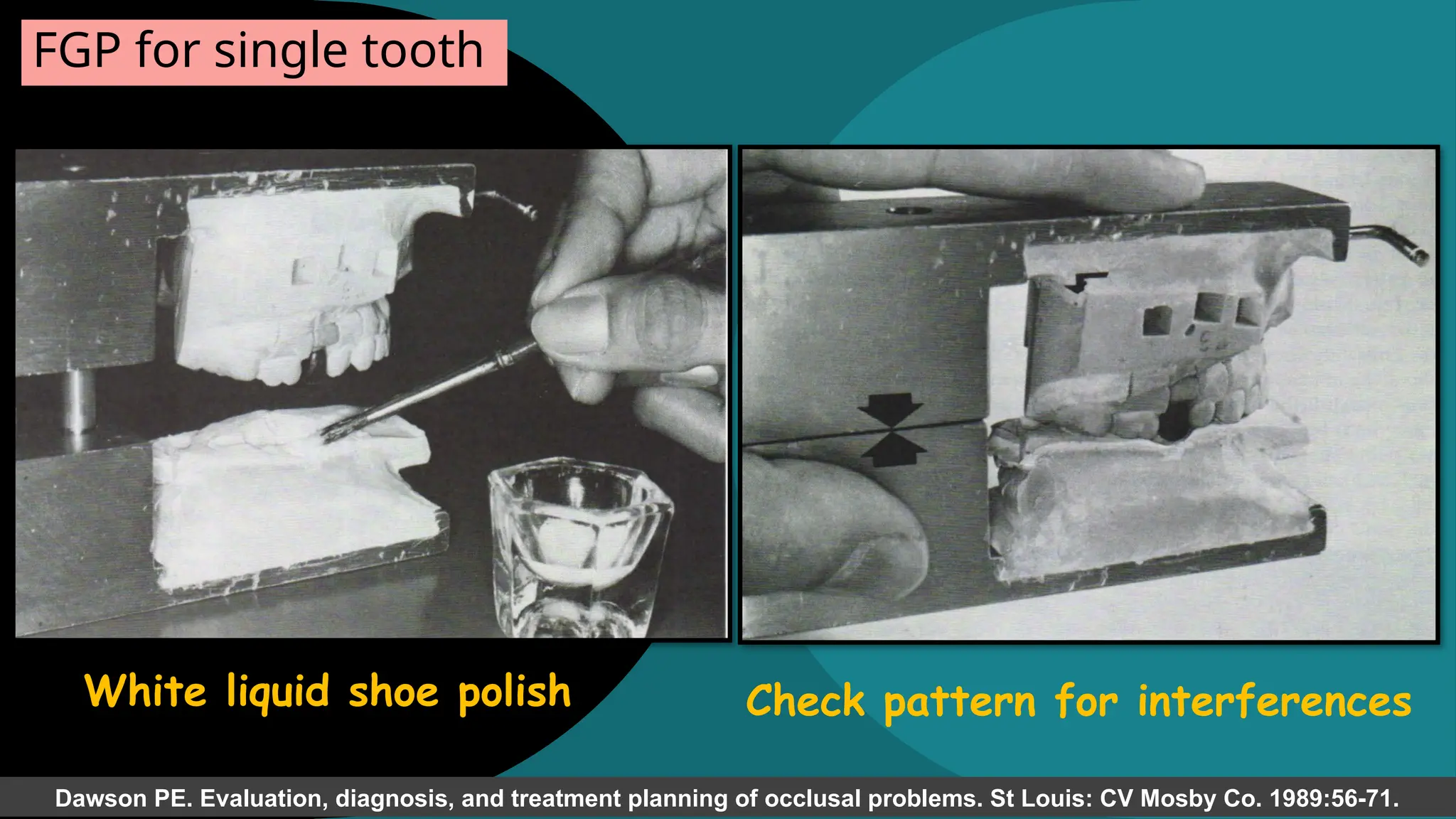 43
White liquid shoe polish
FGP for single tooth
Dawson PE. Evaluation, diagnosis, and treatment planning of occlusal problems. St Louis: CV Mosby Co. 1989:56-71.
Check pattern for interferences
 