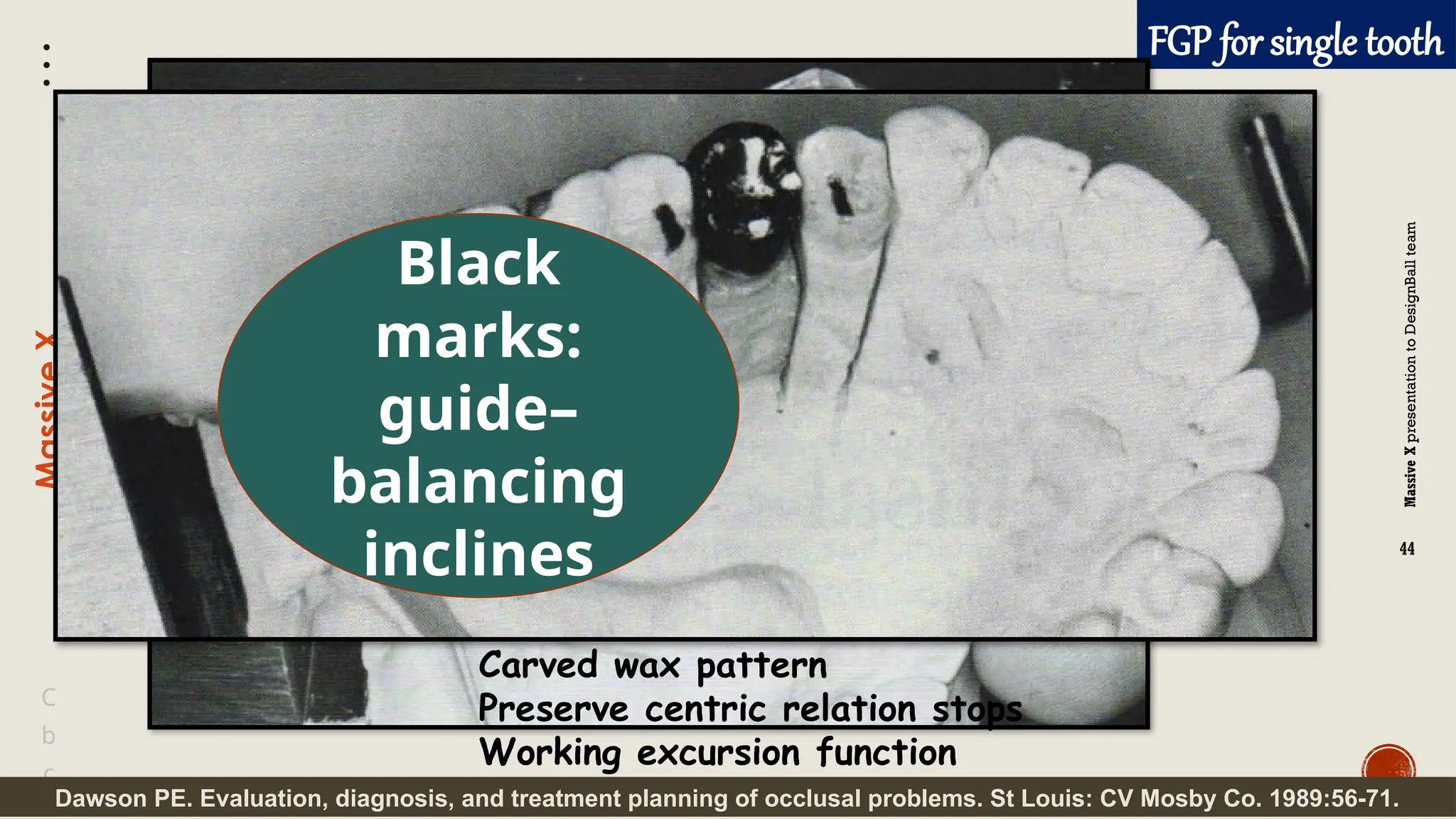 Massive
X
presentation
to
DesignBall
team
Massive
X
44
b
C
c
FGP for single tooth
Dawson PE. Evaluation, diagnosis, and treatment planning of occlusal problems. St Louis: CV Mosby Co. 1989:56-71.
Carved wax pattern
Preserve centric relation stops
Working excursion function
Black
marks:
guide–
balancing
inclines
 
