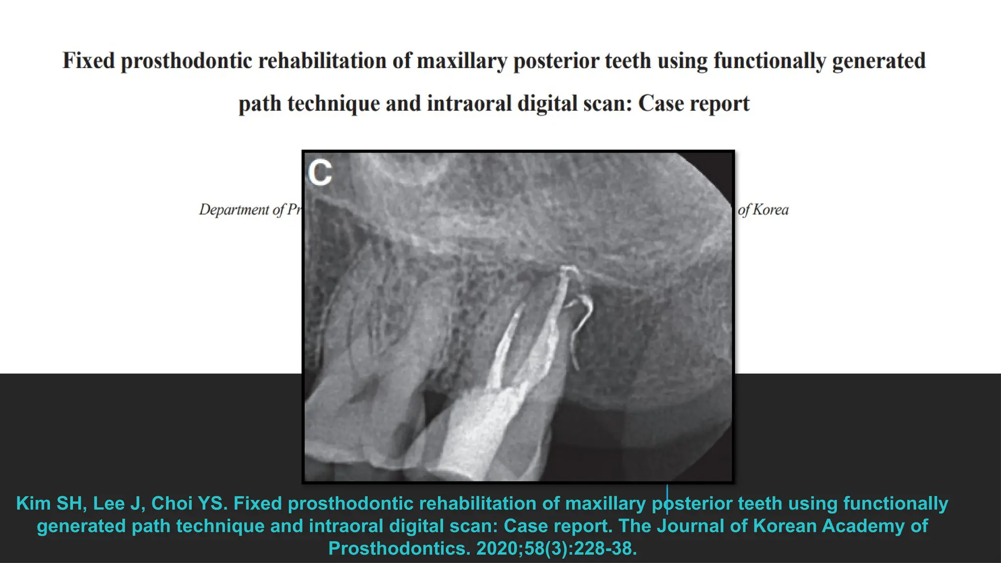 46
Kim SH, Lee J, Choi YS. Fixed prosthodontic rehabilitation of maxillary posterior teeth using functionally
generated path technique and intraoral digital scan: Case report. The Journal of Korean Academy of
Prosthodontics. 2020;58(3):228-38.
 