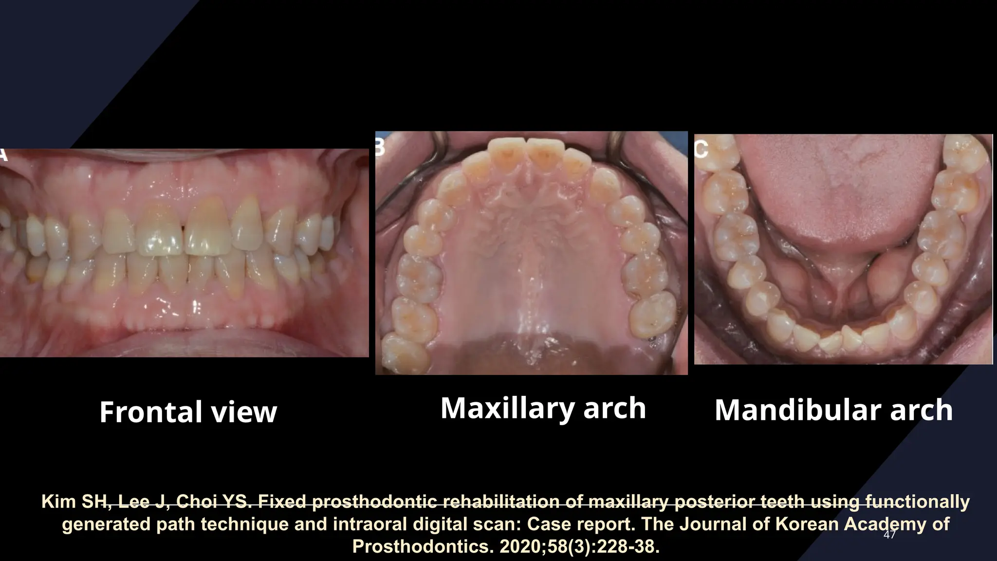 47
Frontal view Maxillary arch Mandibular arch
Kim SH, Lee J, Choi YS. Fixed prosthodontic rehabilitation of maxillary posterior teeth using functionally
generated path technique and intraoral digital scan: Case report. The Journal of Korean Academy of
Prosthodontics. 2020;58(3):228-38.
 