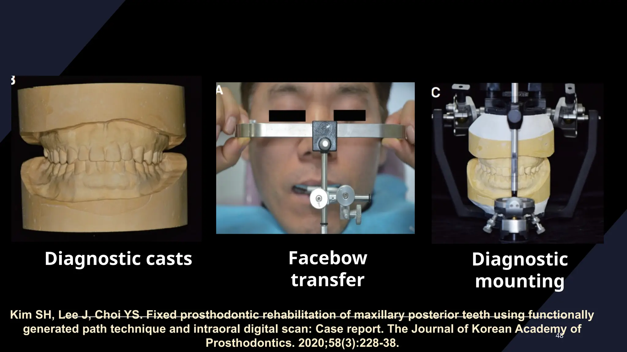 48
Diagnostic casts Facebow
transfer
Diagnostic
mounting
Kim SH, Lee J, Choi YS. Fixed prosthodontic rehabilitation of maxillary posterior teeth using functionally
generated path technique and intraoral digital scan: Case report. The Journal of Korean Academy of
Prosthodontics. 2020;58(3):228-38.
 