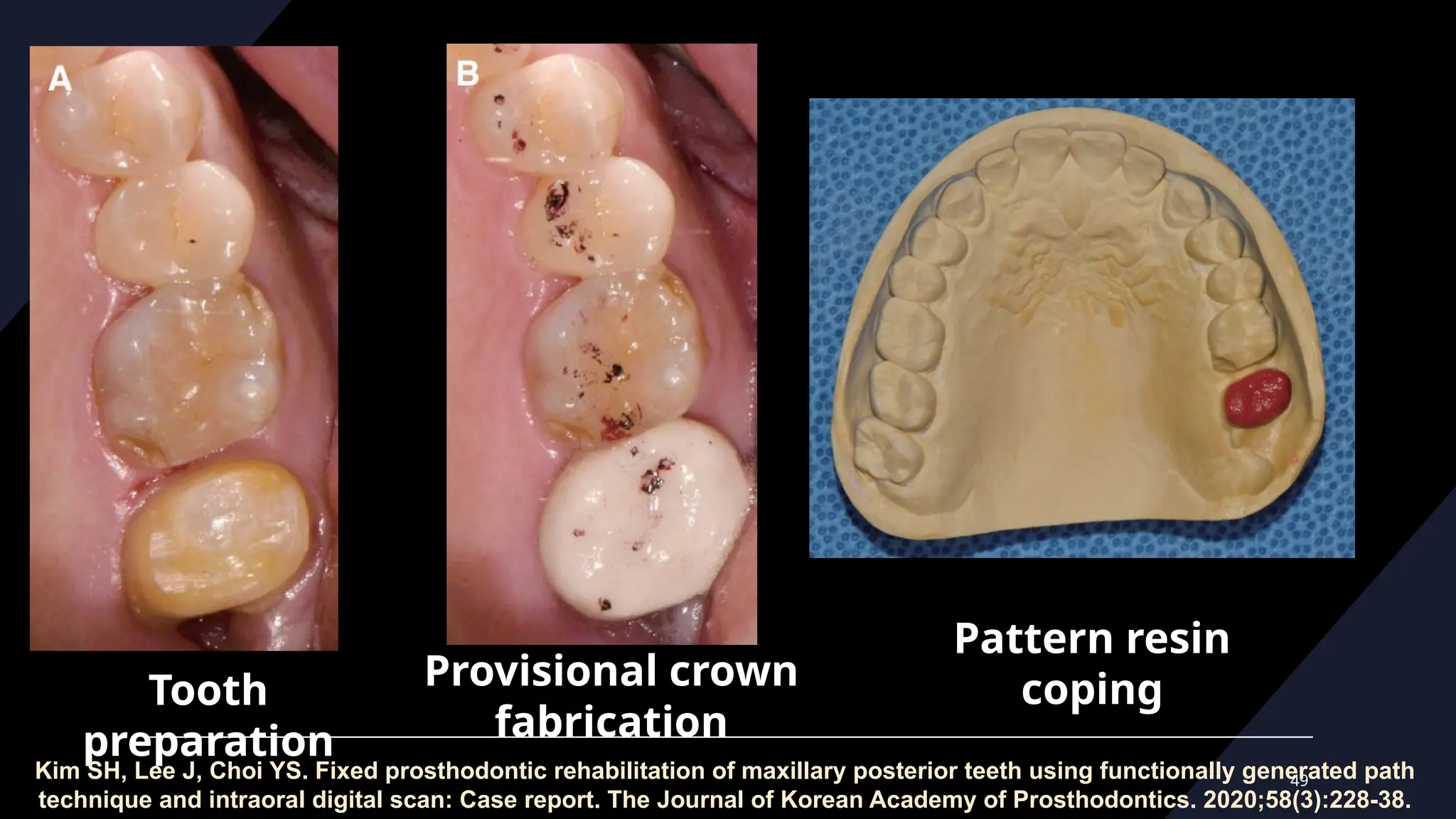 49
Tooth
preparation
Provisional crown
fabrication
Pattern resin
coping
Kim SH, Lee J, Choi YS. Fixed prosthodontic rehabilitation of maxillary posterior teeth using functionally generated path
technique and intraoral digital scan: Case report. The Journal of Korean Academy of Prosthodontics. 2020;58(3):228-38.
 