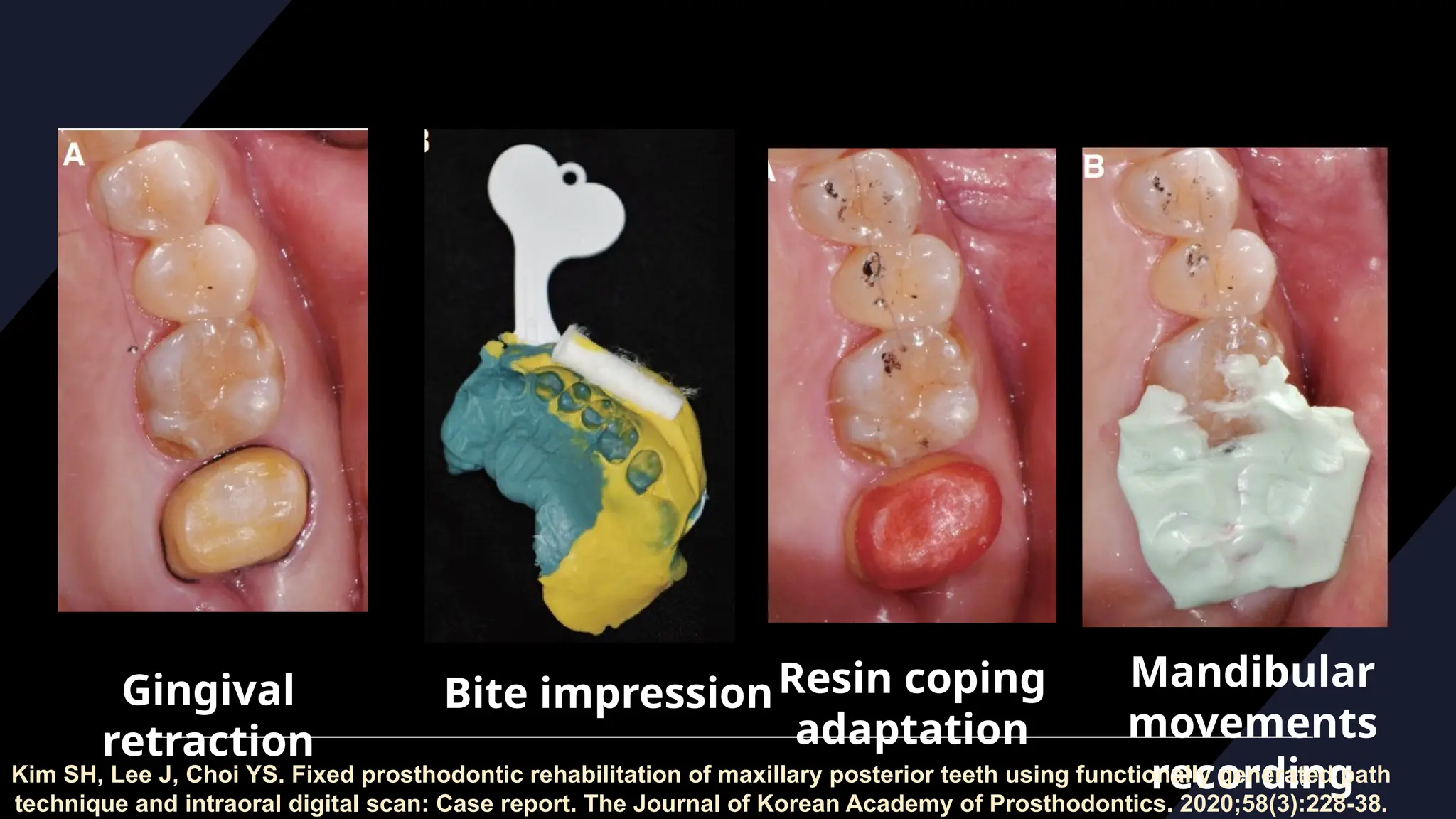 50
Gingival
retraction
Bite impressionResin coping
adaptation
Mandibular
movements
recording
Kim SH, Lee J, Choi YS. Fixed prosthodontic rehabilitation of maxillary posterior teeth using functionally generated path
technique and intraoral digital scan: Case report. The Journal of Korean Academy of Prosthodontics. 2020;58(3):228-38.
 