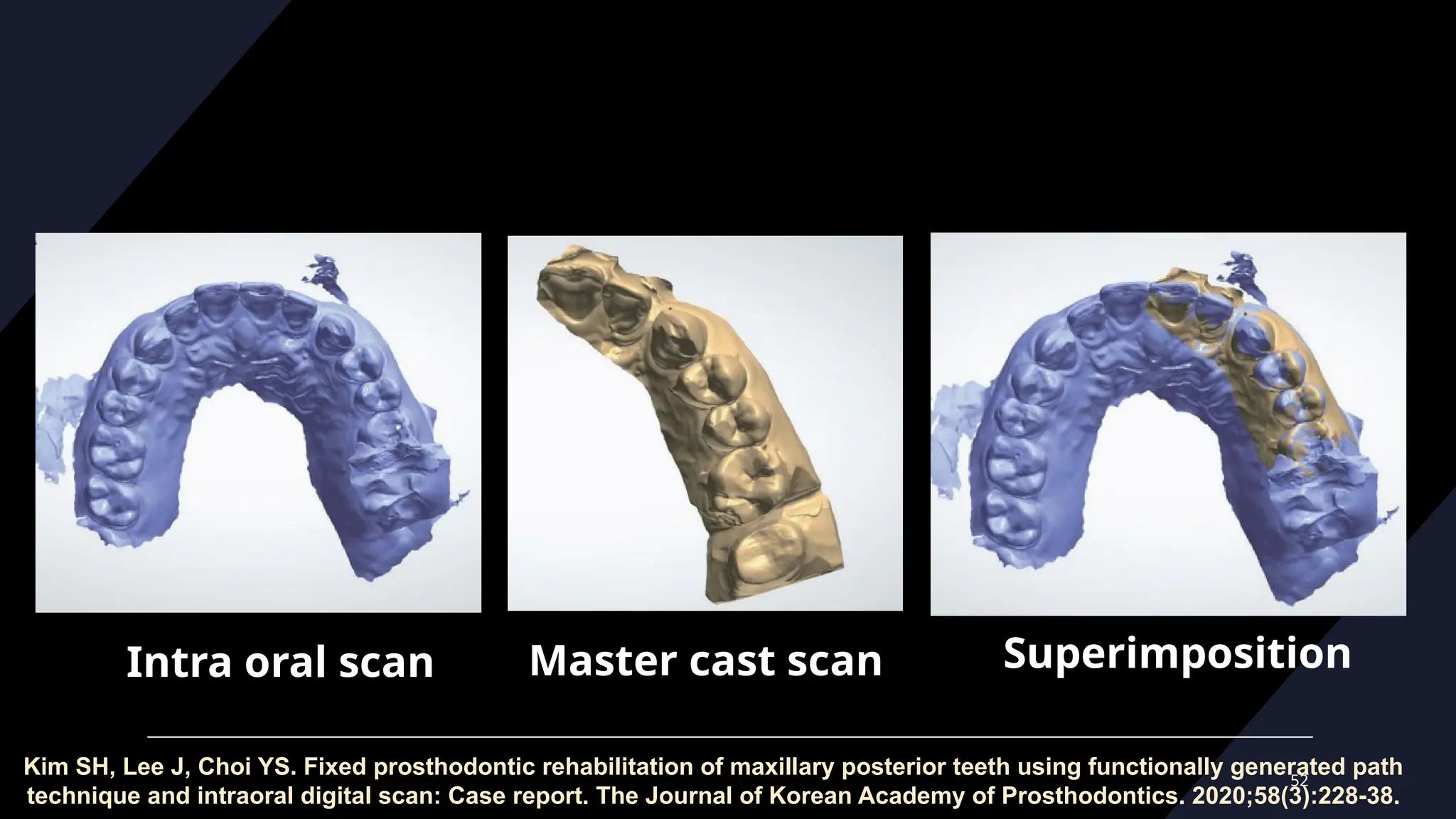 52
Intra oral scan Master cast scan Superimposition
Kim SH, Lee J, Choi YS. Fixed prosthodontic rehabilitation of maxillary posterior teeth using functionally generated path
technique and intraoral digital scan: Case report. The Journal of Korean Academy of Prosthodontics. 2020;58(3):228-38.
 